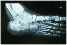 13in x 17in Giấy chẩn đoán hình ảnh X Ray phân hủy cho máy in Laser