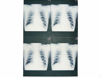 Hình ảnh chẩn đoán y tế 20 cm x 25cm, Máy in Laser Phim X Ray