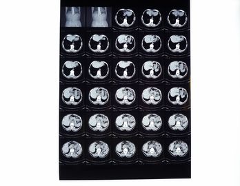 Phim X quang y tế, Phim chụp ảnh khô tương thích với máy in nhiệt cho CT / DR / MRI